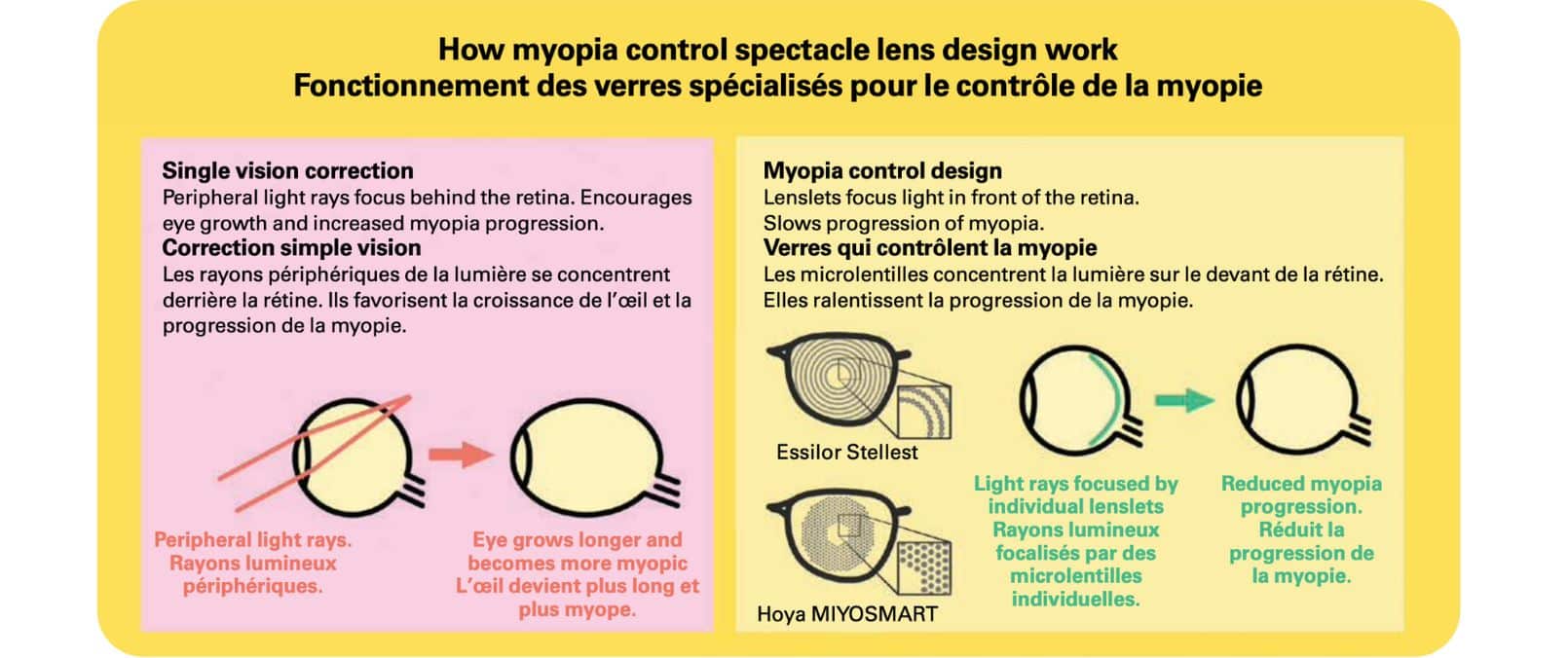 An infographic explaining how myopia control spectacle lens designs work for treating childhood myopia. On the left, under "Single vision correction," it states that peripheral light rays focus behind the retina, encouraging eye growth and increased myopia progression. The diagram shows peripheral light rays focusing behind the retina, leading to the eye growing longer and becoming more myopic. On the right, under "Myopia control design," it explains that lenslets focus light in front of the retina, slowing the progression of myopia. The diagram includes illustrations of the Essilor Stellest and Hoya MIYOSMART lenses, showing light rays focused by individual lenslets and reduced myopia progression. All of the text also appears in French.